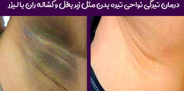 عکس زیر بغل لیزر شده