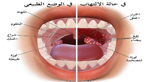 عکس گلوی کرونایی