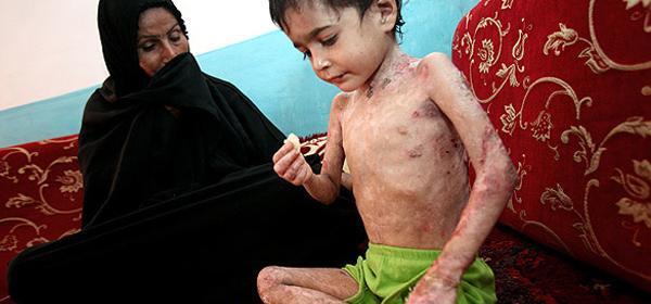 عکس پسر بچه ای که بدنش عقرب تولید میکنه