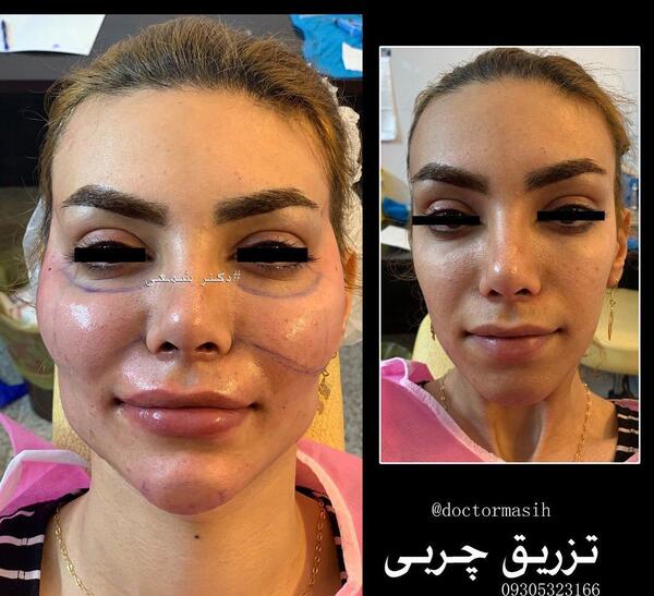 عکس تزریق چربی به بغل ران