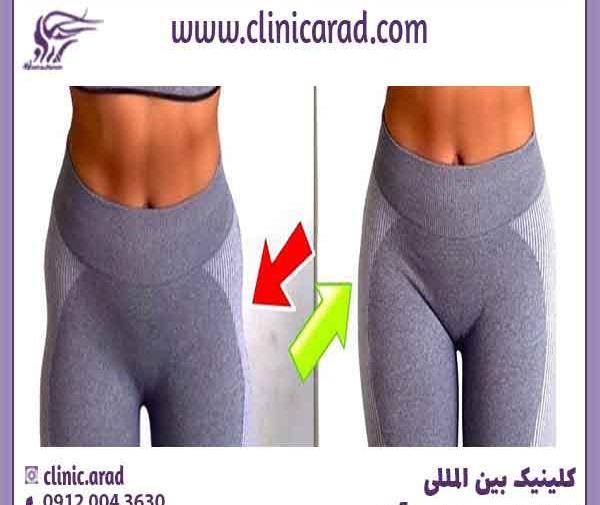 عکس تزریق چربی به بغل ران