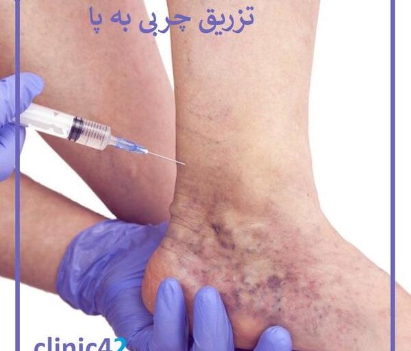 عکس تزریق چربی به بغل ران