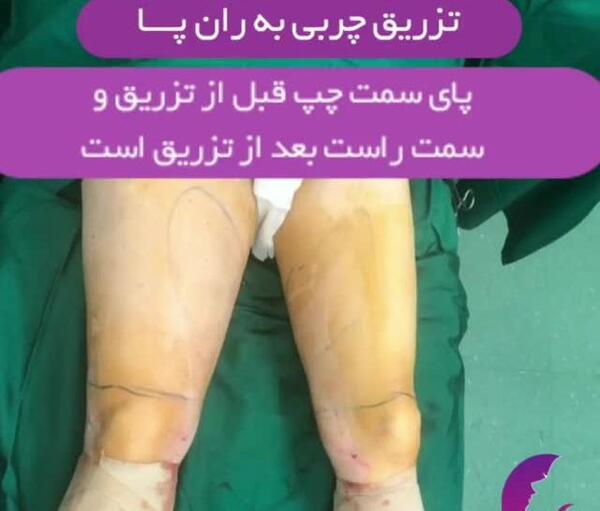 عکس تزریق چربی به بغل ران