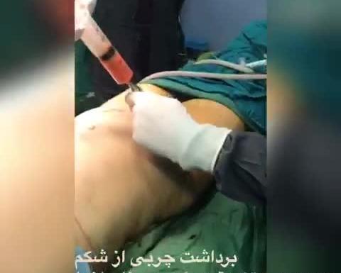 عکس تزریق چربی به بغل ران