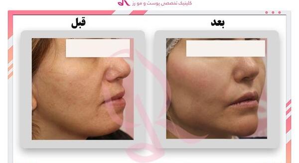 عکس تزریق چربی به بغل ران