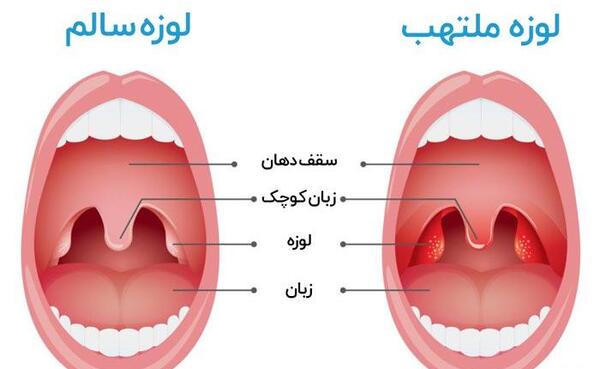عکس لوزه کرونایی