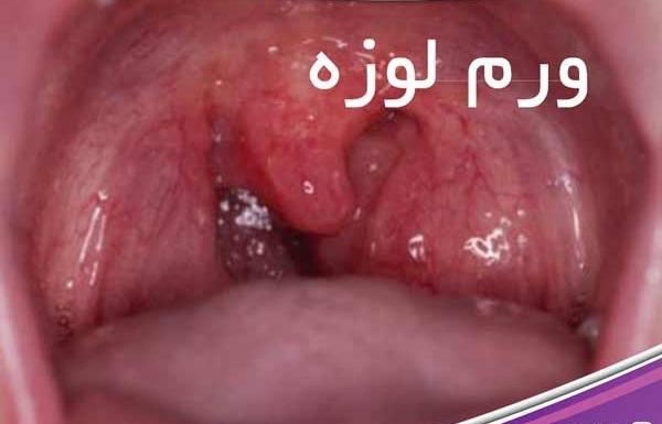 عکس لوزه کرونایی