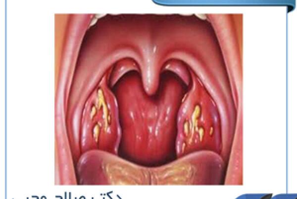 عکس لوزه کرونایی