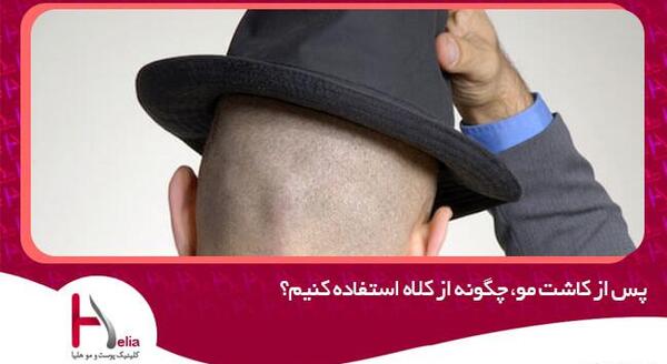 عکس کلاه پشمی بعد از کاشت مو