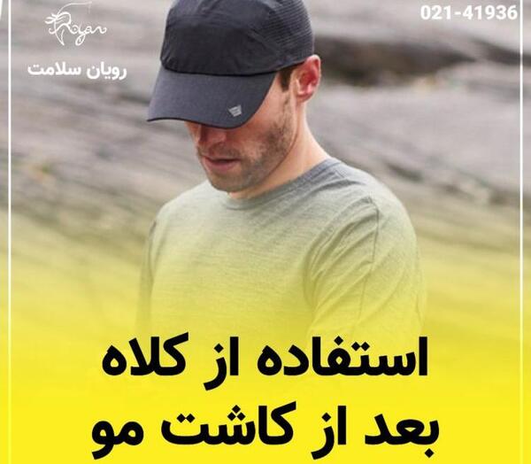 عکس کلاه پشمی بعد از کاشت مو