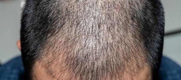 عکس کلاه پشمی بعد از کاشت مو
