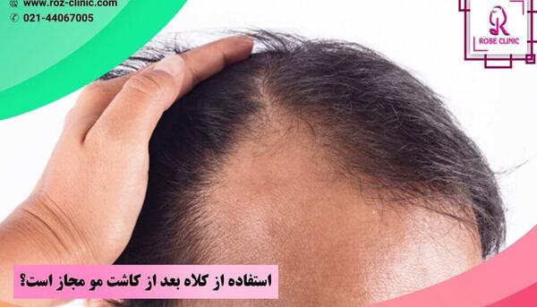 عکس کلاه پشمی بعد از کاشت مو