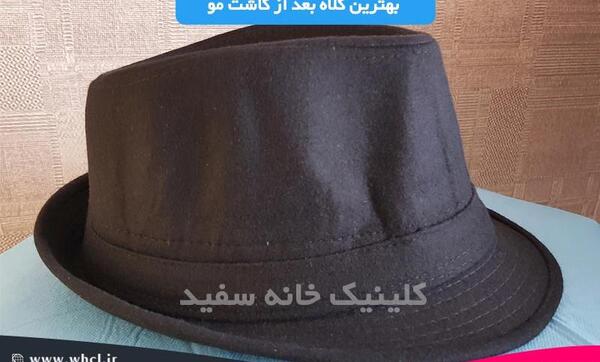 عکس کلاه پشمی بعد از کاشت مو