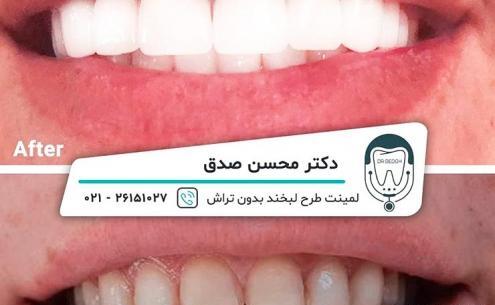 عکس های قبل و بعد عروس