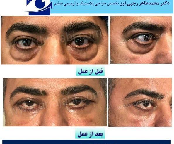 عکس کلاه طرح پلک
