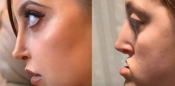 عکس زنان عمل زیبایی