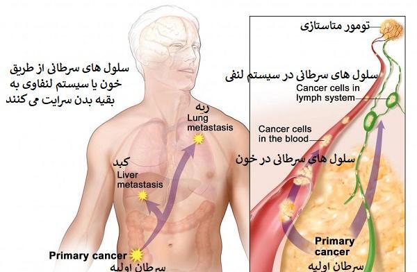 عکس متاستاز ریه