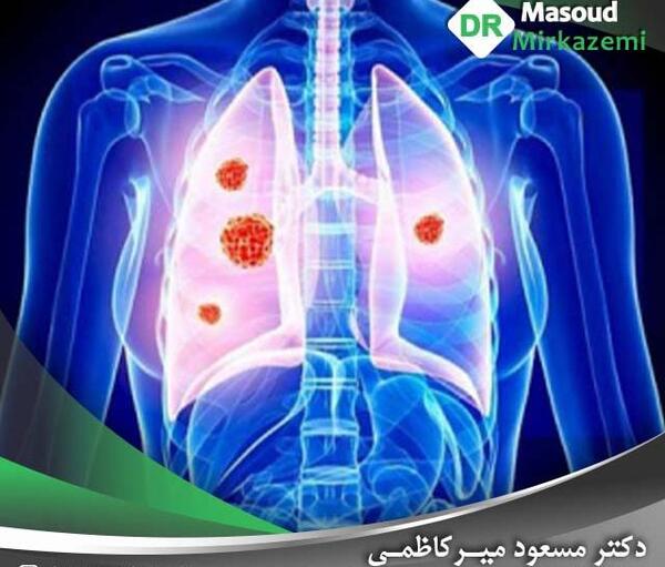 عکس متاستاز ریه
