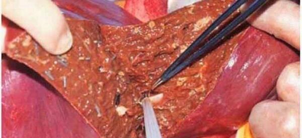 عکس متاستاز ریه