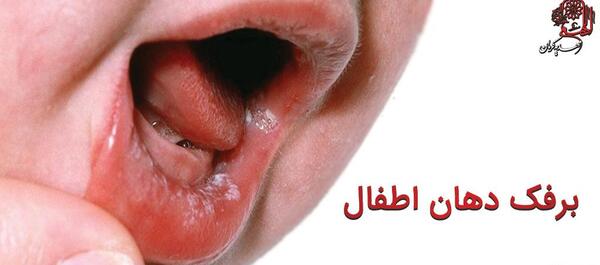 عکس برفک دهان نوزاد