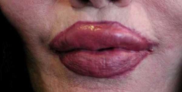 عکس پروتز لب دختر اهوازی
