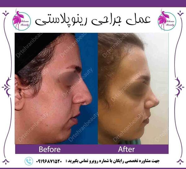 عکس آتلیه عمل بینی