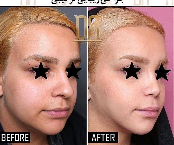 عکس آتلیه عمل بینی