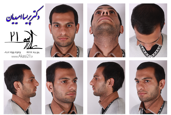 عکس آتلیه عمل بینی