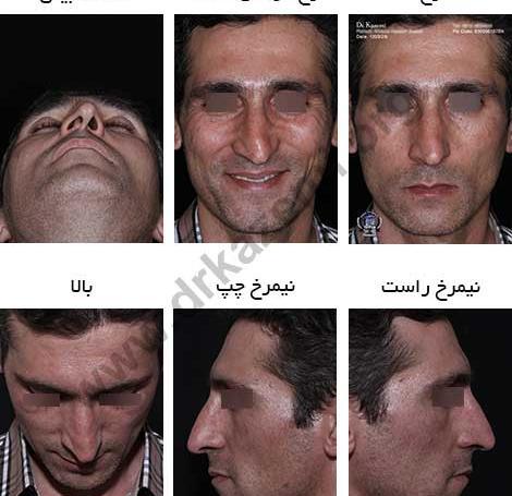 عکس آتلیه عمل بینی