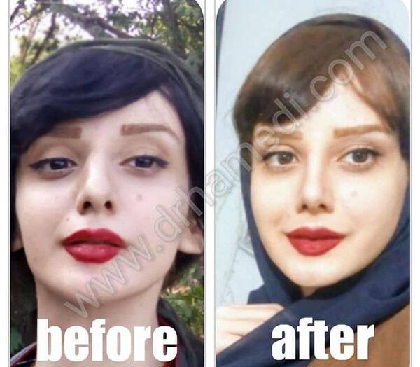 عکس آتلیه عمل بینی