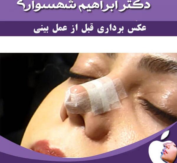 عکس آتلیه عمل بینی