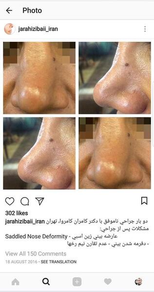 عکس اتلیه قبل عمل بینی نی نی سایت