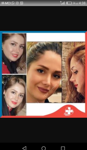 عکس اتلیه قبل عمل بینی نی نی سایت