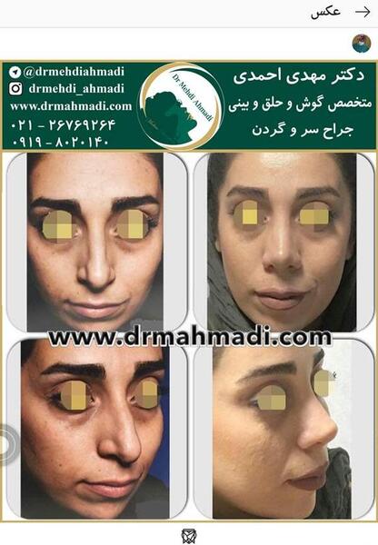 عکس اتلیه قبل عمل بینی نی نی سایت