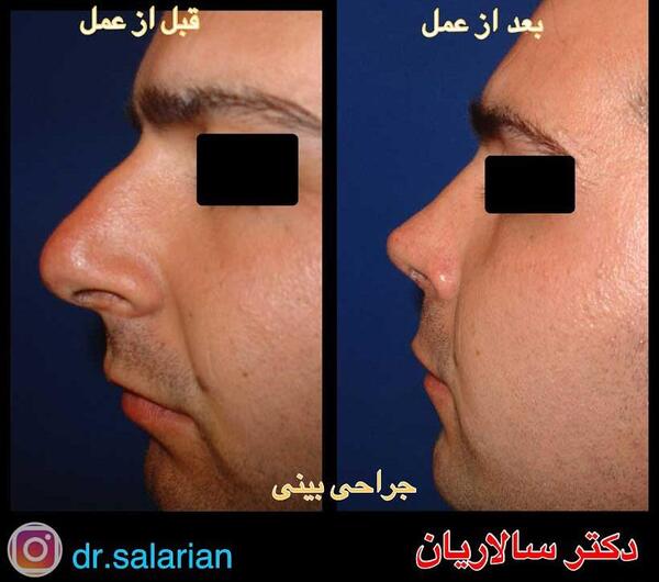 عکس اتلیه قبل عمل بینی