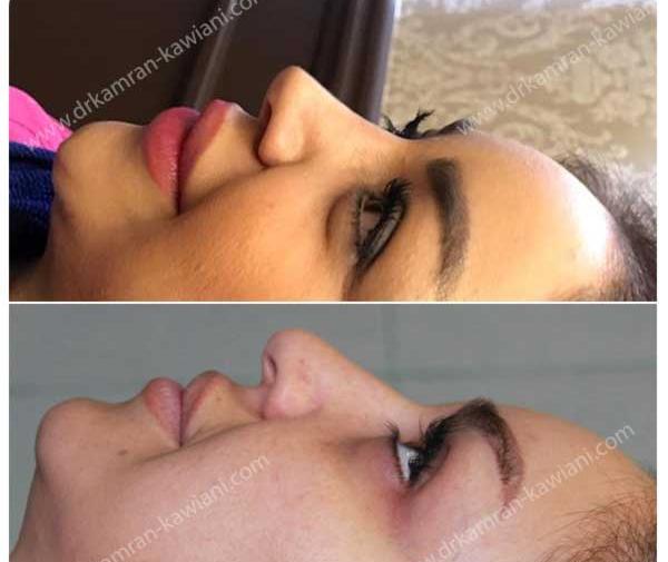عکس اتلیه قبل عمل بینی