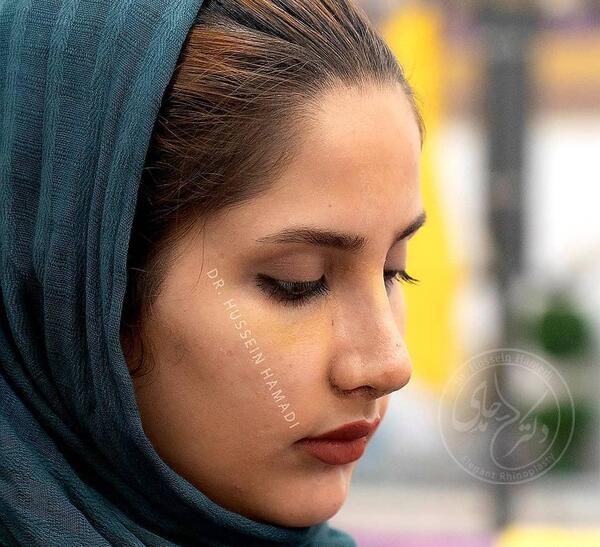 عکس اتلیه قبل عمل بینی