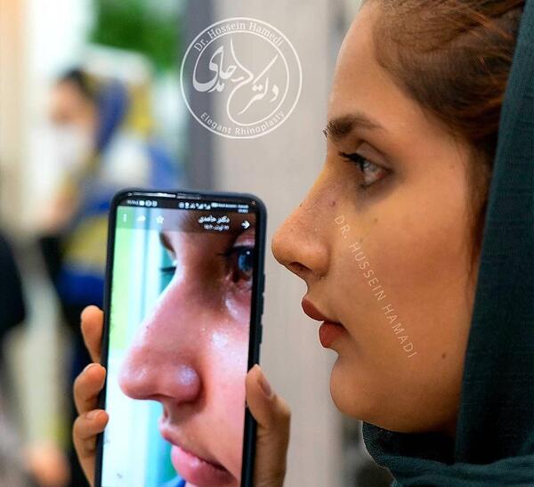 عکس اتلیه قبل عمل بینی