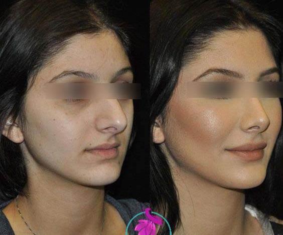 عکس اتلیه قبل عمل بینی