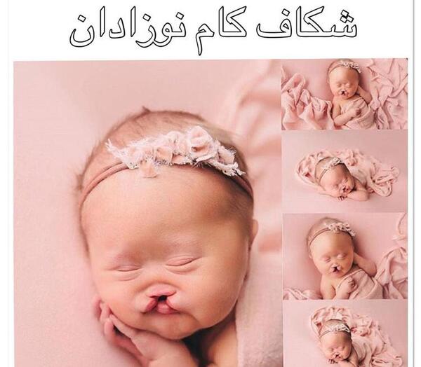 عکس کودک لب شکری