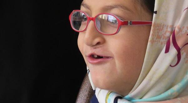 عکس کودک لب شکری
