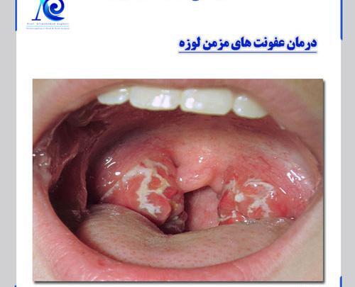 عکس و تصویر آبسه لوزه