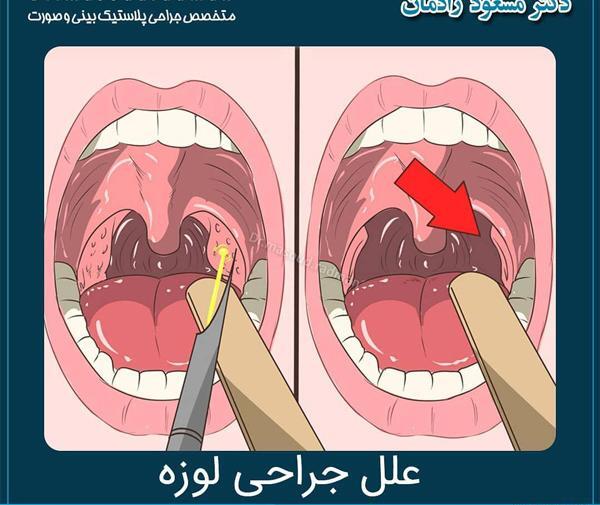 عکس و تصویر آبسه لوزه