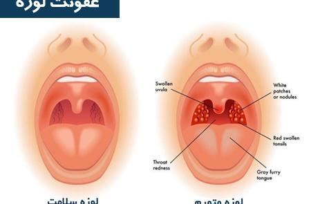 عکس و تصویر آبسه لوزه