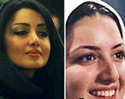 عکس های فرزاد حسنی قبل از عمل بینی