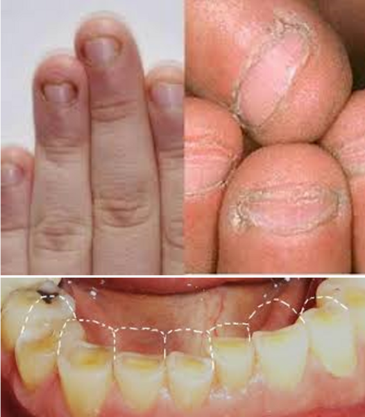 عکس ناخن جویده شده