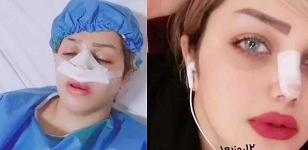 عکس های روشنک گرامی قبل از عمل بینی
