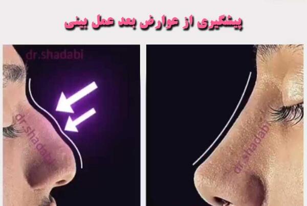 عکس در حال عمل بینی