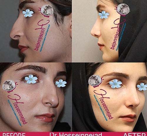 عکس در حال عمل بینی