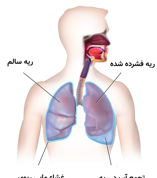 عکس ریه حساس